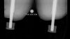 Pre-operative radiograph with bilateral above-knee socket prostheses