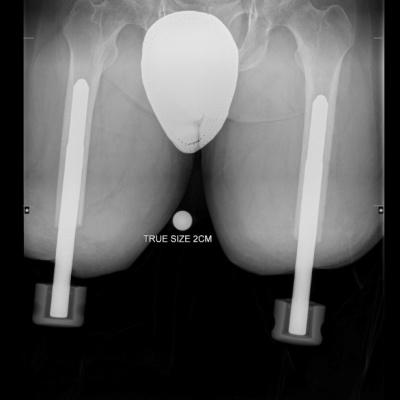 Pre-operative radiograph with bilateral above-knee socket prostheses